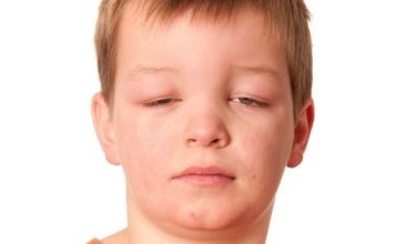 How to Reduce Face Swelling and Get Rid of Puffy Face best dermatologists in Lahore