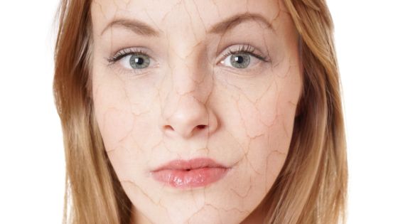 Get Rid of Dry Skin Around Your Mouth Fast With These Home Remedies