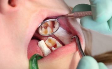 Is it Possible to Reverse The Cavity? Cavity