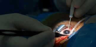 Cataract Surgery